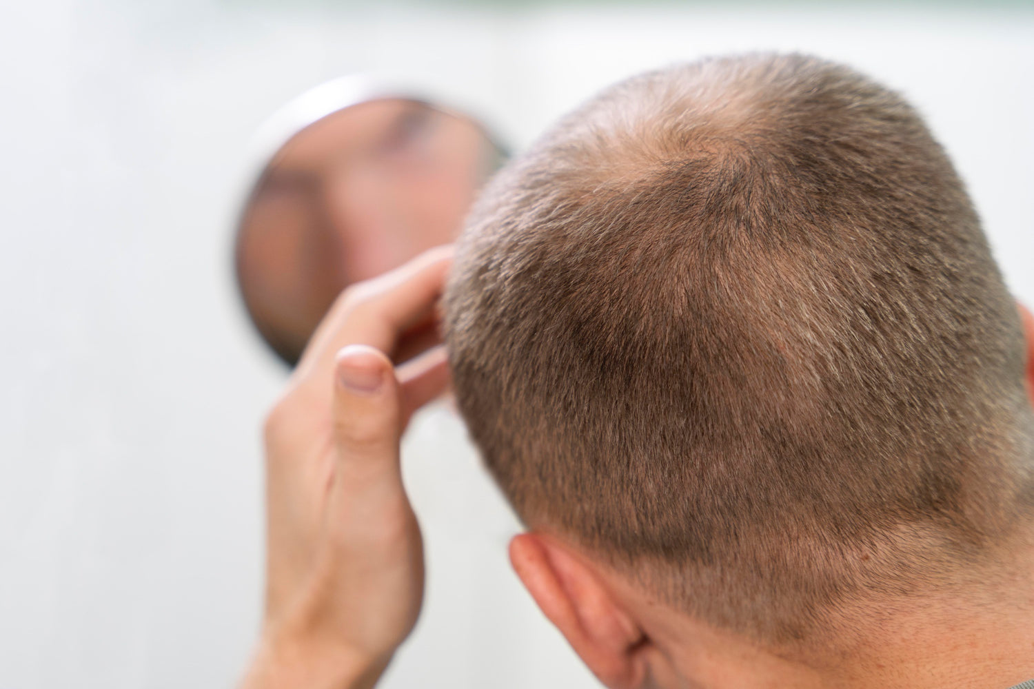 Dealing with Male Pattern Baldness