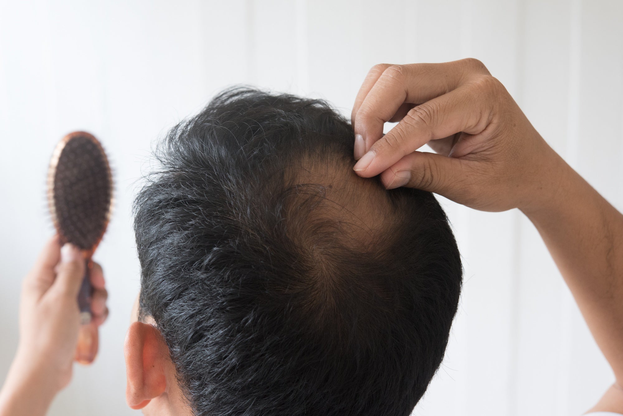 Hair Loss and Confidence: How Reversing Hair Loss Can Boost Self-Esteem